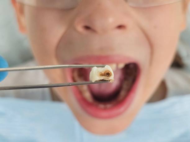 Best Emergency Dentist for Lost Fillings or Crowns in Tukwila, WA